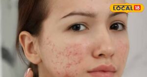 Read more about the article चेहरे पर कील मुंहासे से हैं परेशान तो अपनाएं यह आसान आयुर्वेदिक घरेलू उपचार