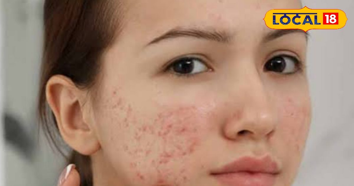 You are currently viewing चेहरे पर कील मुंहासे से हैं परेशान तो अपनाएं यह आसान आयुर्वेदिक घरेलू उपचार