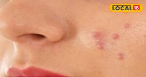 Read more about the article फंक्शन के दो दिन पहले चेहरे पर निकले पिंपल्स तो क्या करें? 3 आसान तरीके से तुरंत मिलेगा आराम