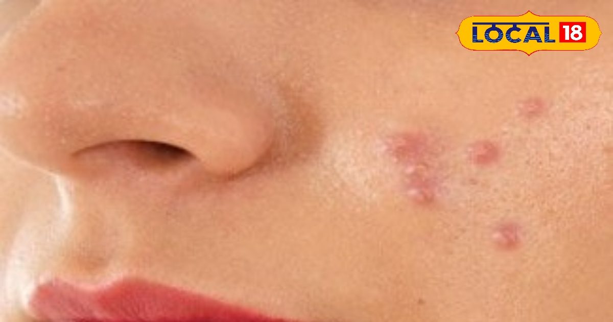 You are currently viewing फंक्शन के दो दिन पहले चेहरे पर निकले पिंपल्स तो क्या करें? 3 आसान तरीके से तुरंत मिलेगा आराम