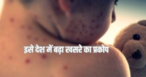 Read more about the article Measles outbreak in Mongolia: मंगोलिया में खसरे के 4 हजार से अधिक मामले, जानें इस बीमारी के कारण, लक्षण