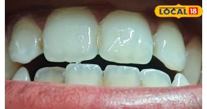 Read more about the article दांतों की सफेदी के लिए आयुर्वेदिक उपाय: भुवनेश पांडे के सुझाव.