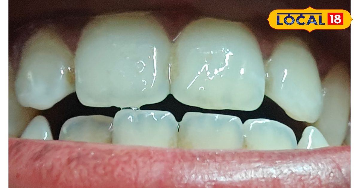 You are currently viewing दांतों की सफेदी के लिए आयुर्वेदिक उपाय: भुवनेश पांडे के सुझाव.