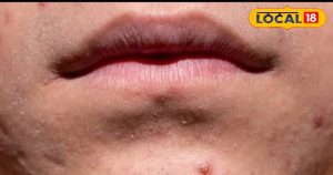 Read more about the article पिंपल्स का जड़ से सफाया करेंगी ये 7 चीजें, आपको घर पर आसानी से मिल जाएंगी