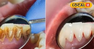 Read more about the article Tips And Tricks: दांतों के दर्द से परेशान…? किचन की ये चीज बनेगी रामबाण इलाज, मिनटों में मिलेगा आराम!