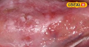 Read more about the article Oral Cancer Symptoms: निमाड़वासियों के लिए साइलेंट किलर बना ओरल कैंसर, एक्सपर्ट से जानें लक्ष्ण और बचाव के उपाय