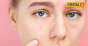 Read more about the article चेहरे पर काले धब्बों से ऐसे पाएं छुटकारा, अपनाएं ये आसान तरीके, चेहरे पर आ जाएगी ग्लोइंग