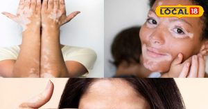 Read more about the article Vitiligo Treatment: सफेद दाग से हैं परेशान, तो भोपाल के वैध जी करेंगे जड़ी-बूटियों से इलाज..सिर्फ 10 दिन में दिखेगा असर