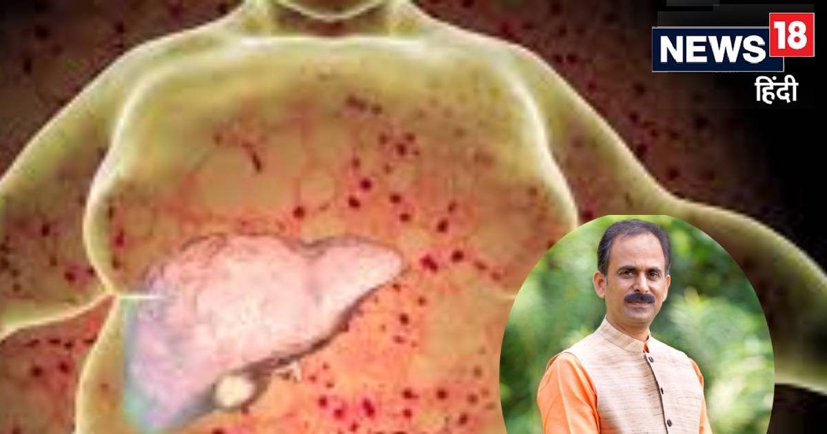 You are currently viewing फैटी ल‍िवर की छुट्टी! 4 हफ्तों में बॉडी होगी डिटॉक्स, आचार्य मनीष ने बताया कैसे काम करती है शुद्धि किटpet yakrit pleeha shudhhi kit by acharya manish for fatty liver