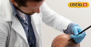 Read more about the article Delhi Top 8 Hair Transplant Doctors: दिल्ली के ये हैं टॉप 8 हेयर ट्रांसप्लांट डाक्टर, सहवाग समेत बदली है हजारों की जिंदगी